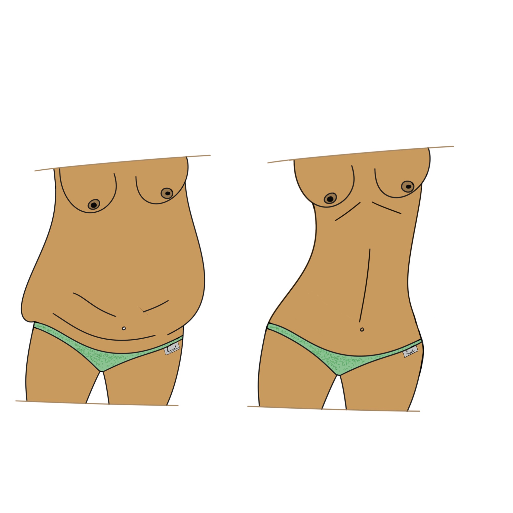 Abdominoplasty illustration — Dr. Sinnet Roy
