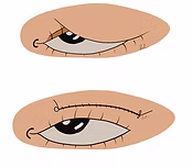 Blepharoplasty Results