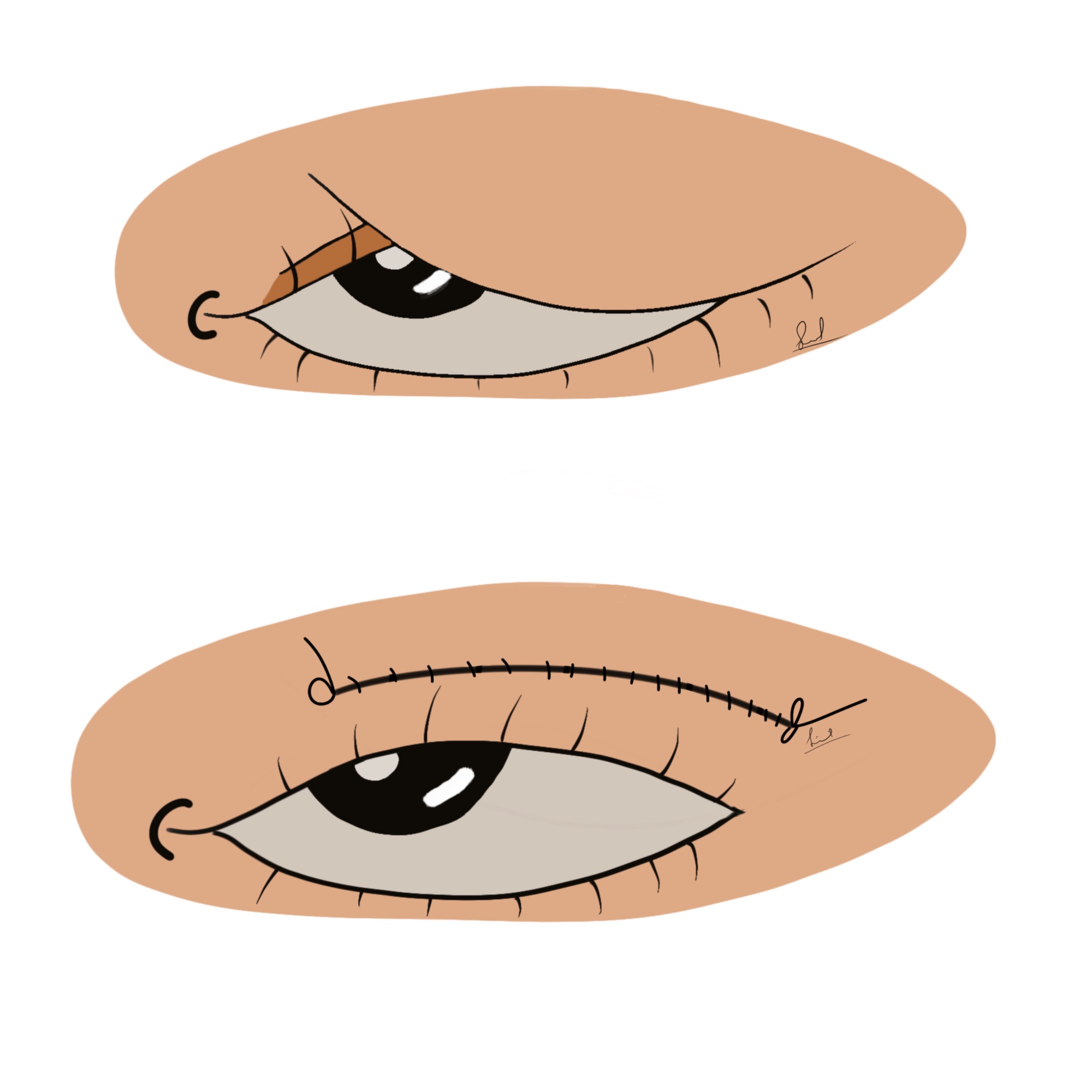 Blepharoplasty illustration — Dr. Sinnet Roy