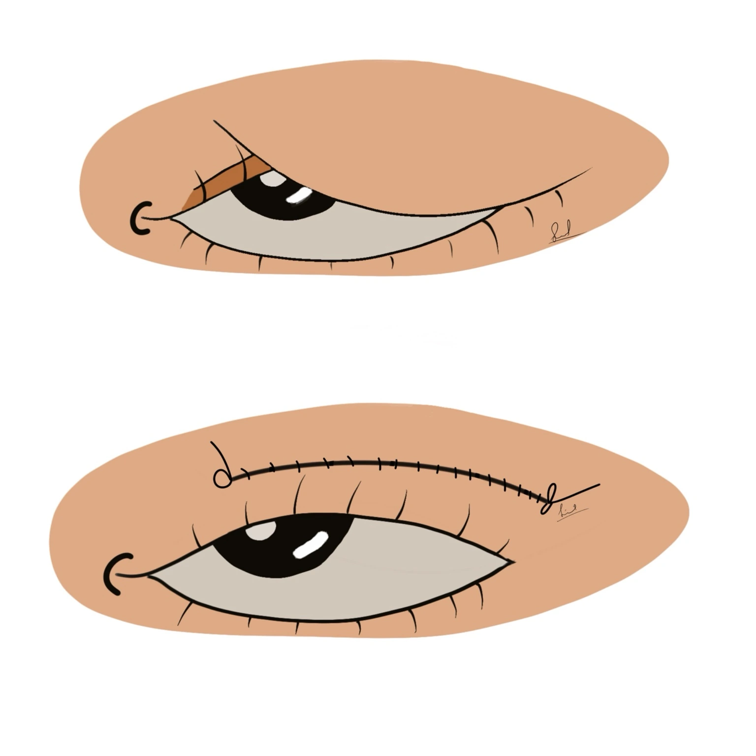 Blepharoplasty illustration