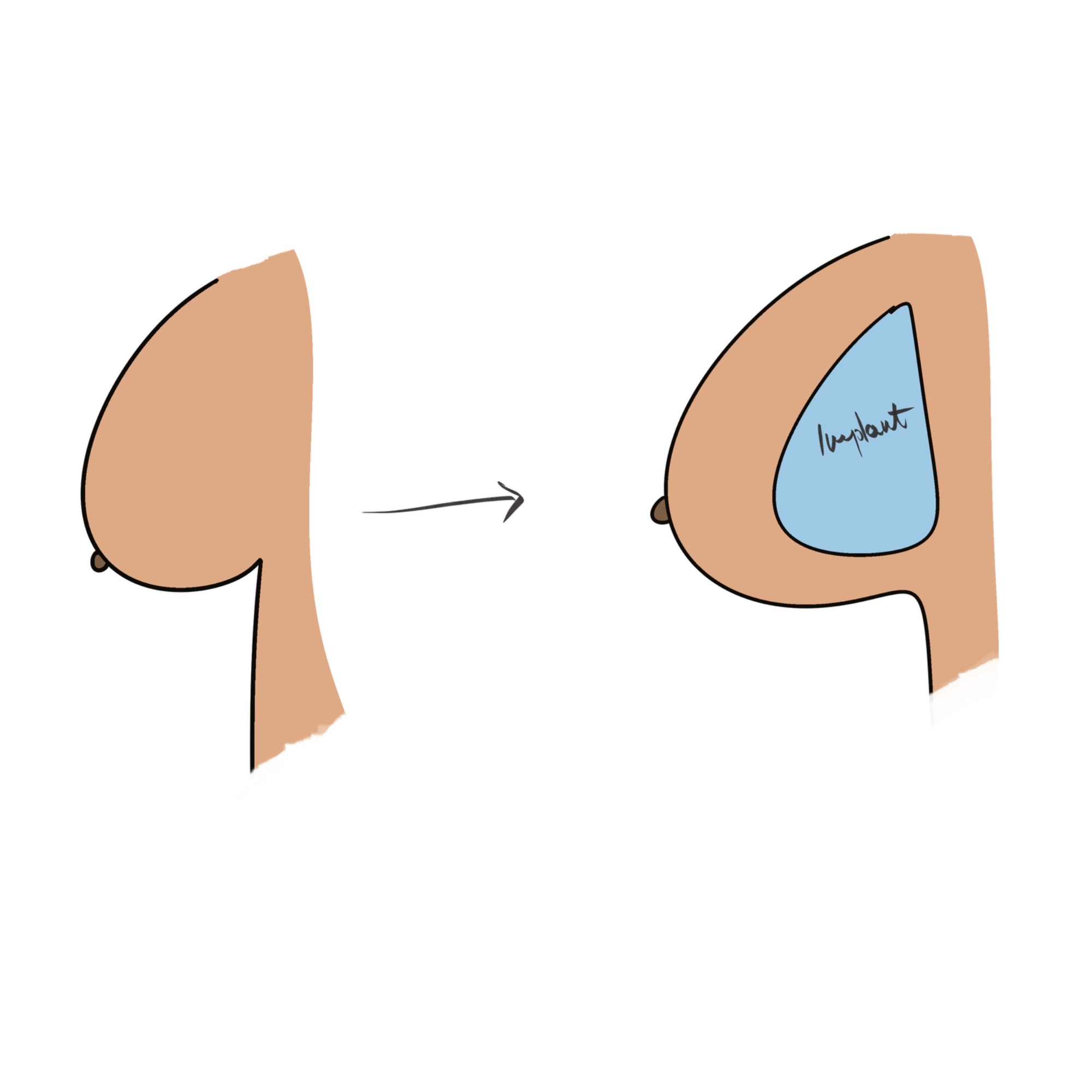 Breast Augmentation illustration — Dr. Sinnet Roy