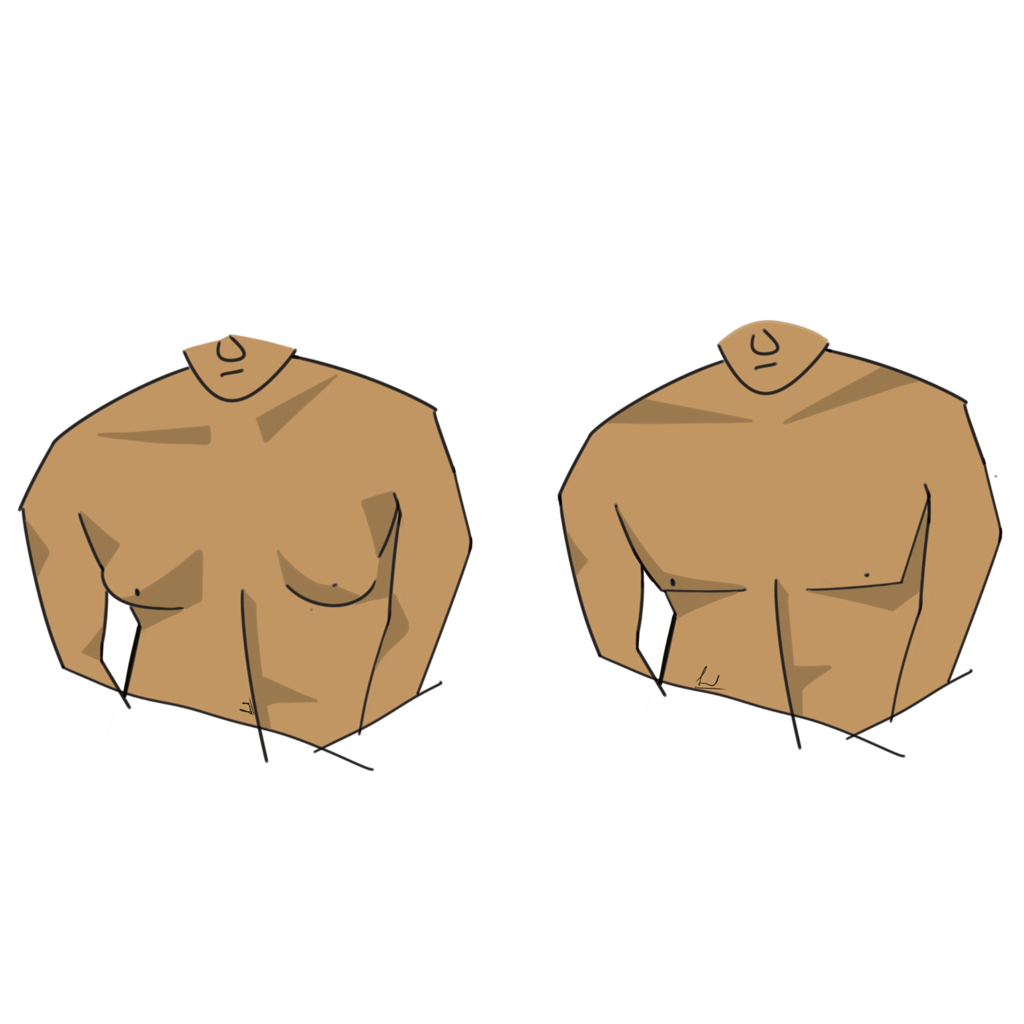 Gynecomastia illustration — Dr. Sinnet Roy