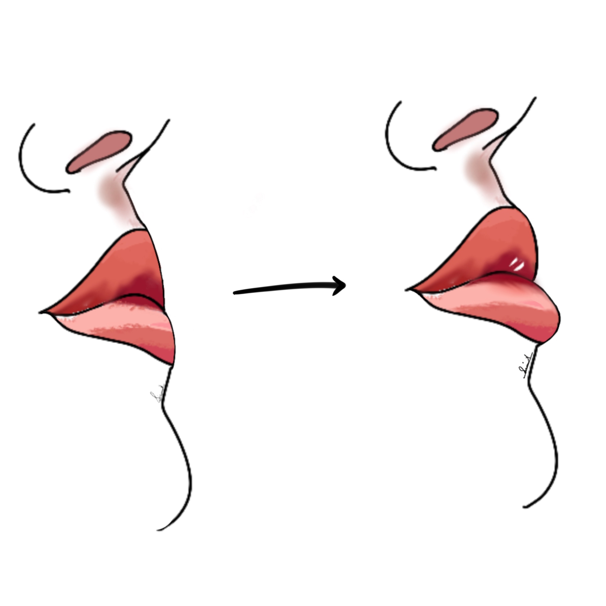 Lip Augmentation illustration