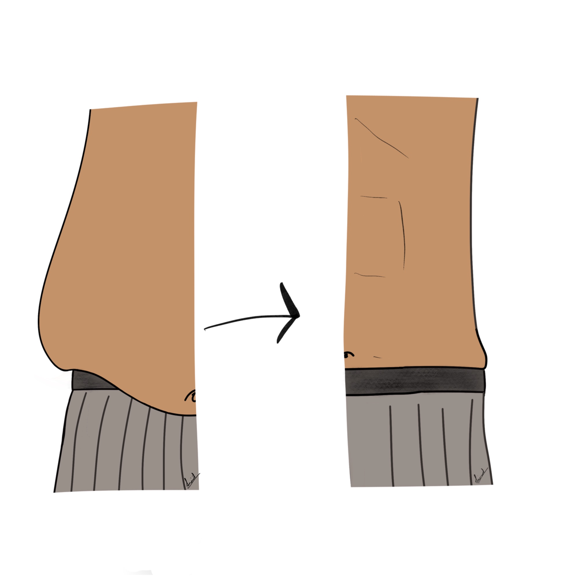 Liposuction illustration — Dr. Sinnet Roy