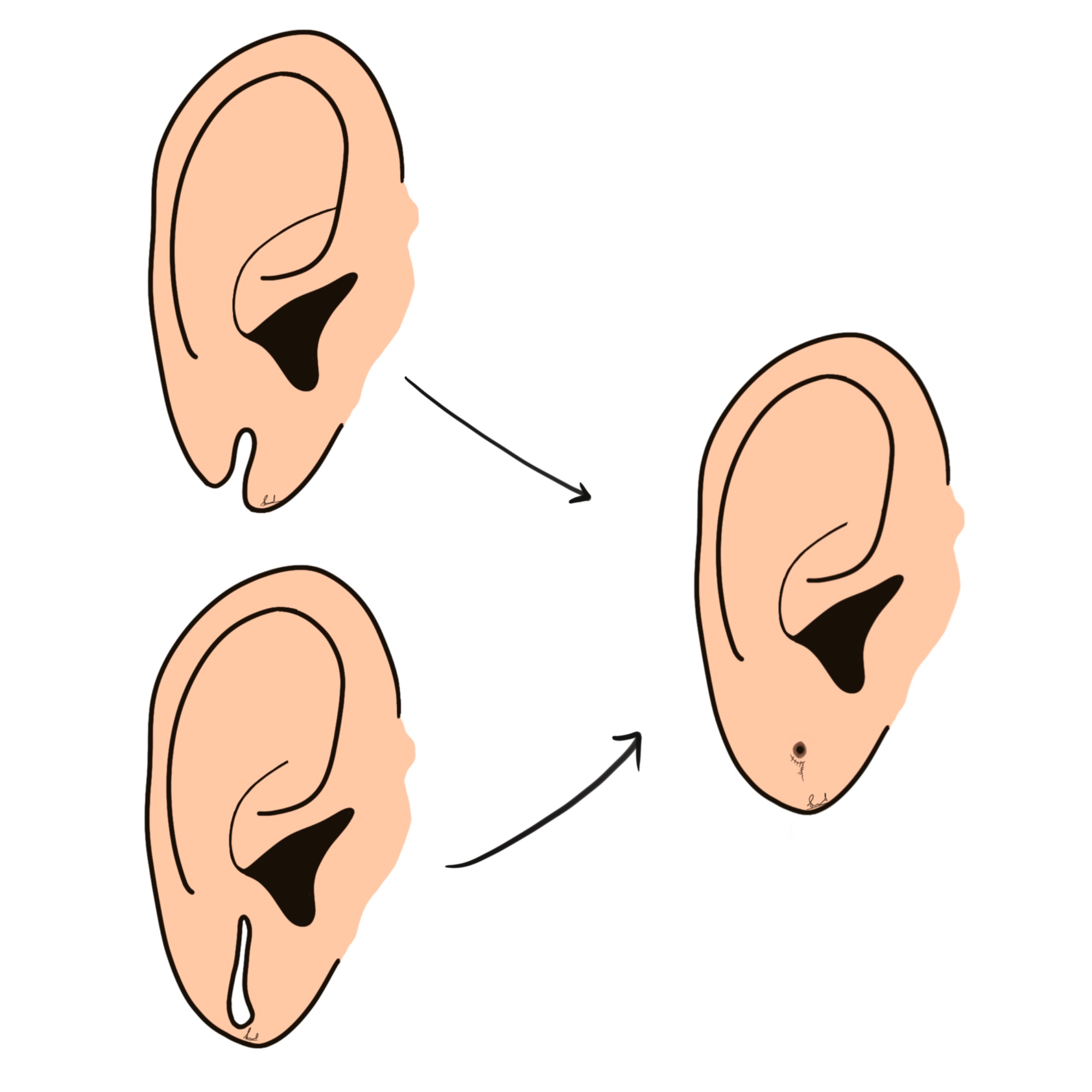 Lobuloplasty illustration — Dr. Sinnet Roy
