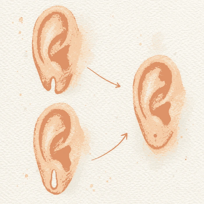 Lobuloplasty illustration
