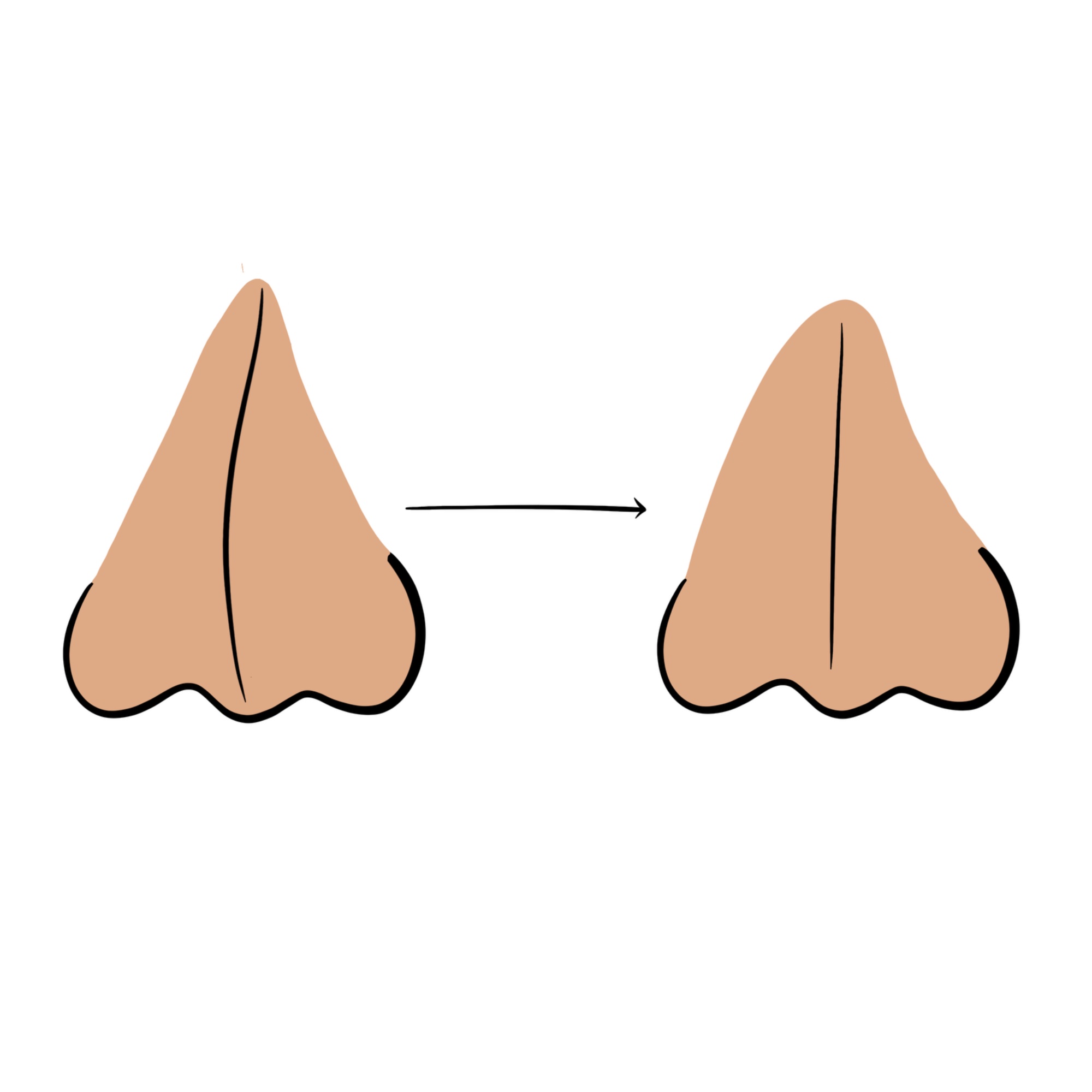 Rhinoplasty illustration — Dr. Sinnet Roy